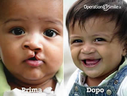 Operation Smile